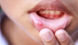 White Bumps on the Lips: Causes and When to Seek Help
